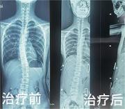 孩子总是坐不直，可能是这个原因！